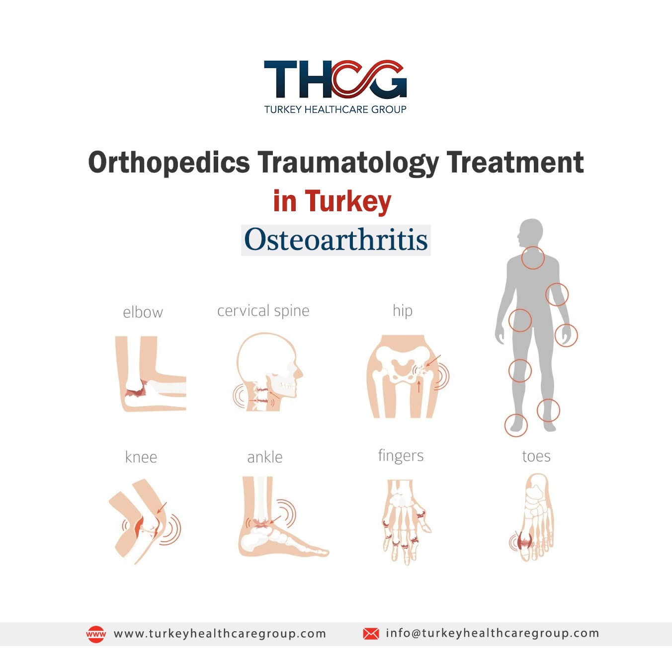 Orthopedics Traumatology Treatment in Turkey