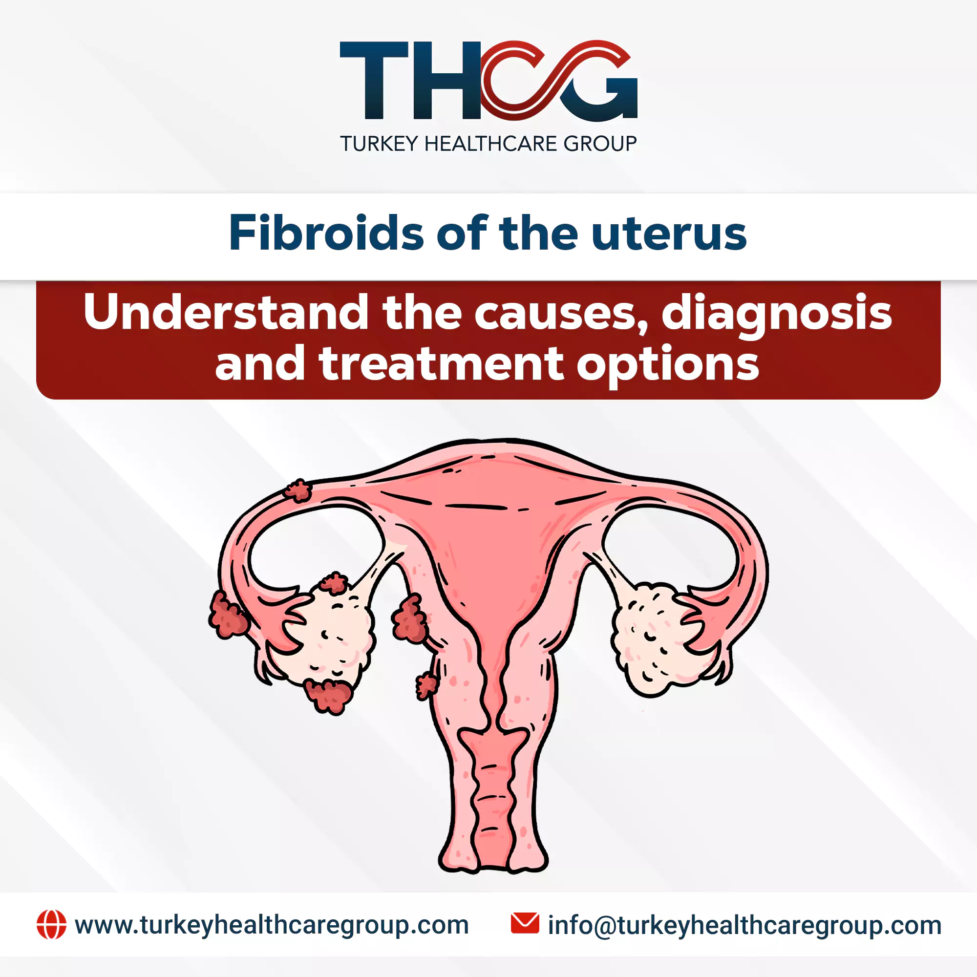 Fibroids of the uterus Uterine fibroids