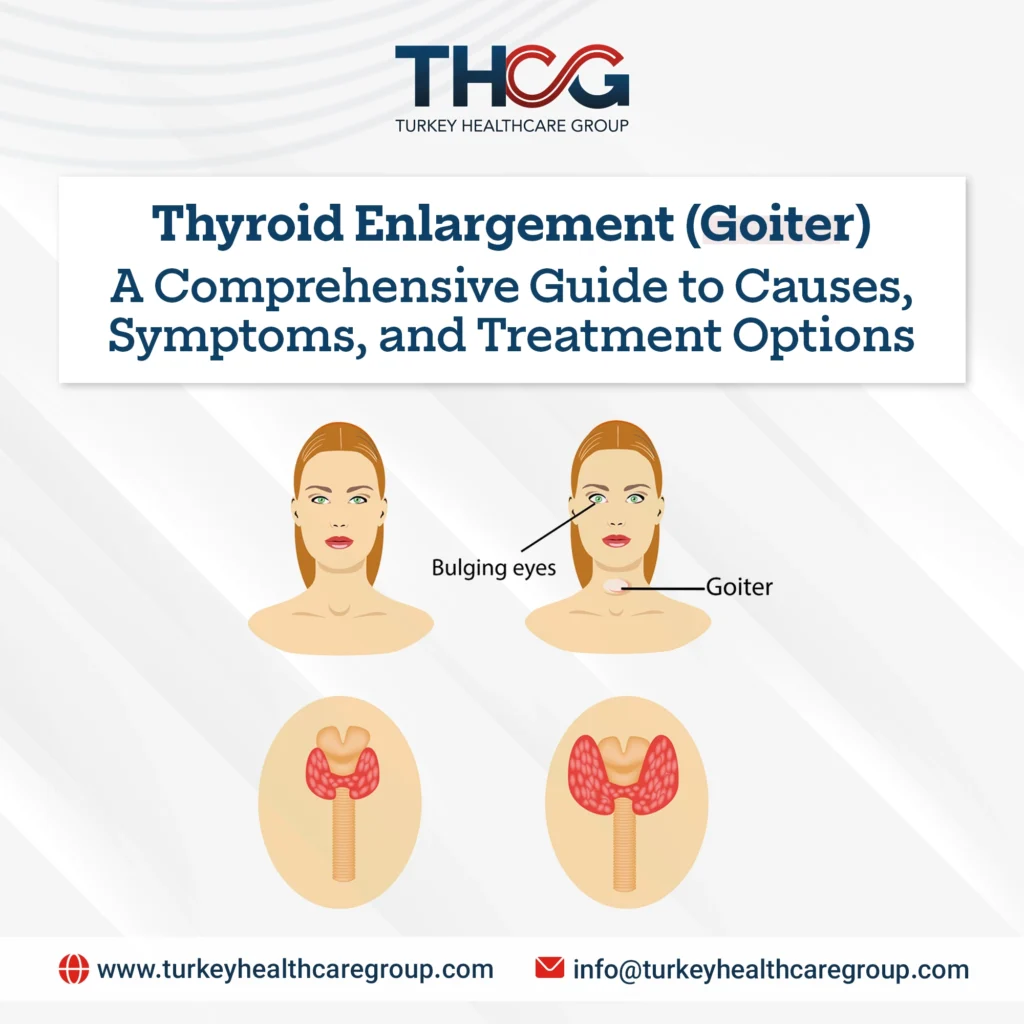 Thyroid Enlargement (Goiter)