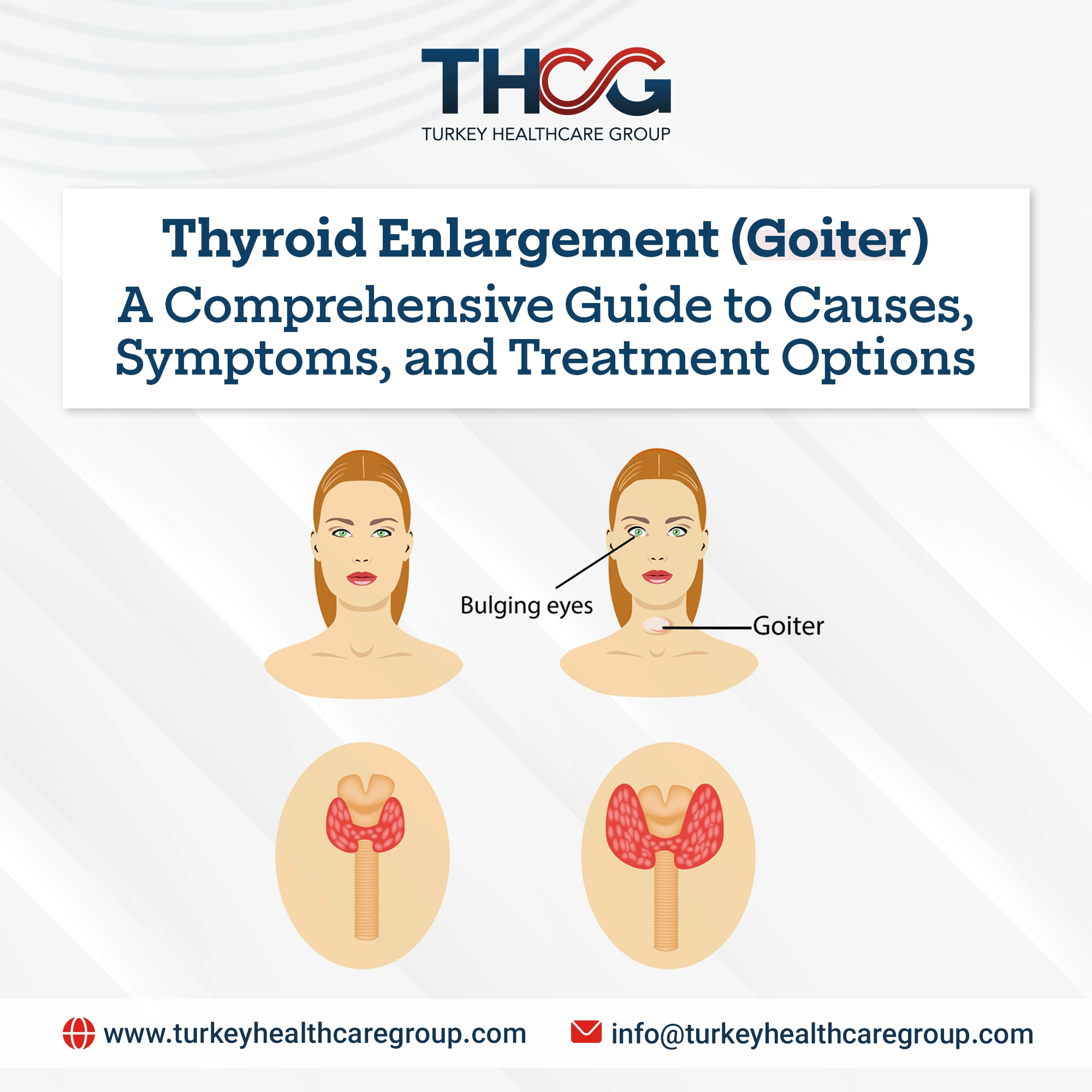 Thyroid Enlargement (Goiter)